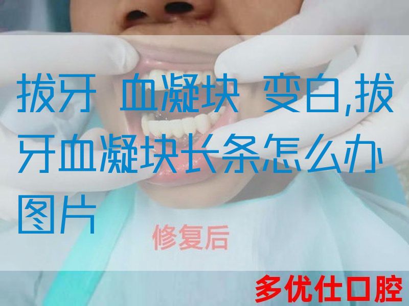 拔牙 血凝块 变白,拔牙血凝块长条怎么办图片(图1)