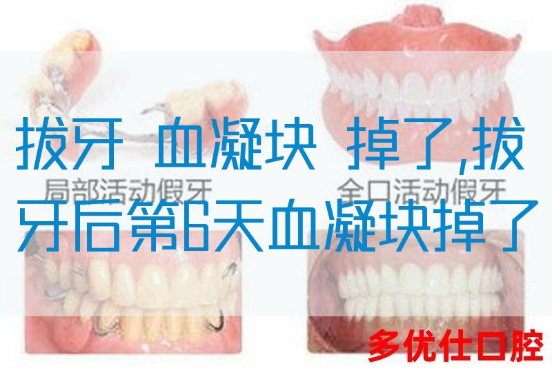 拔牙 血凝块 掉了,拔牙后第6天血凝块掉了(图1)