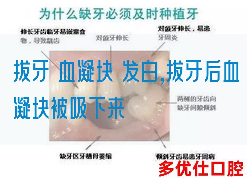 拔牙 血凝块 发白,拔牙后血凝块被吸下来(图1)