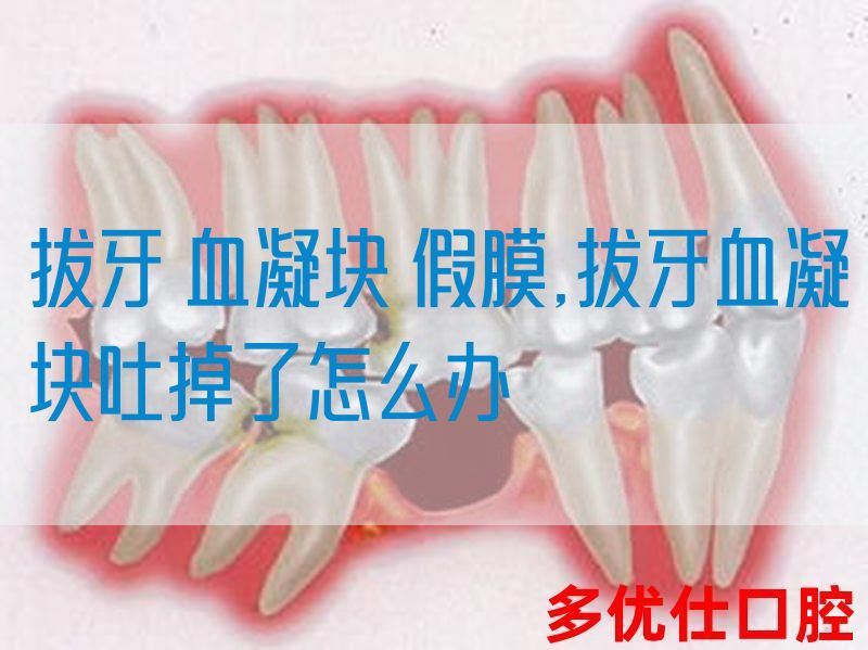拔牙 血凝块 假膜,拔牙血凝块吐掉了怎么办(图1)