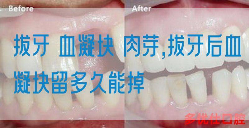 拔牙 血凝块 肉芽,拔牙后血凝块留多久能掉(图1)