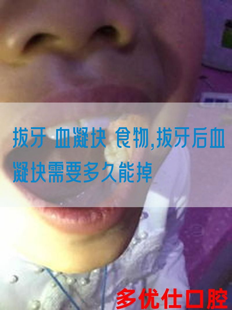 拔牙 血凝块 食物,拔牙后血凝块需要多久能掉(图1)