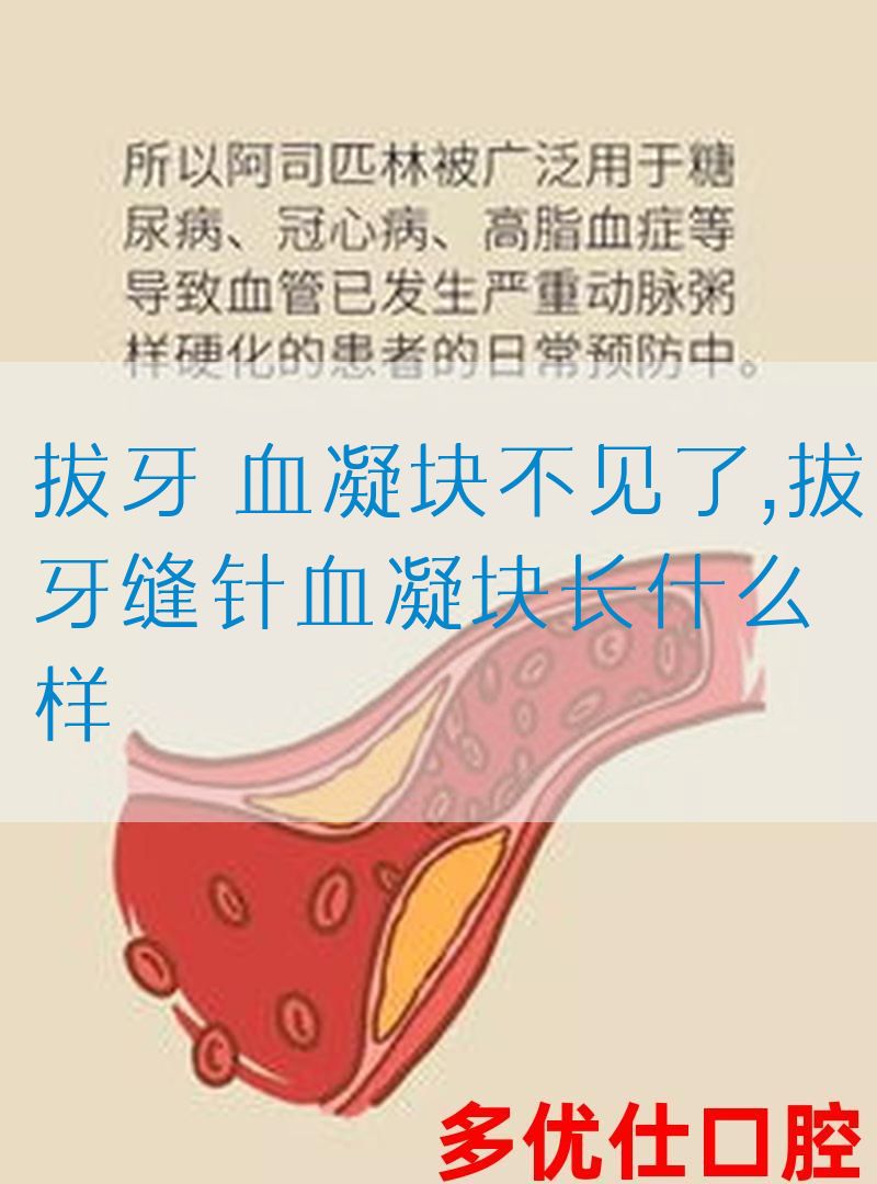 拔牙 血凝块不见了,拔牙缝针血凝块长什么样(图1)