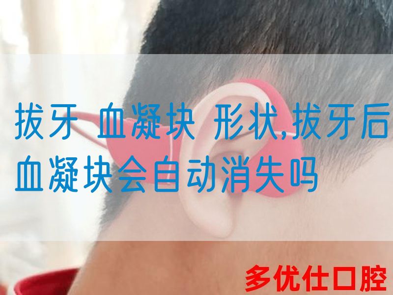 拔牙 血凝块 形状,拔牙后血凝块会自动消失吗(图1)