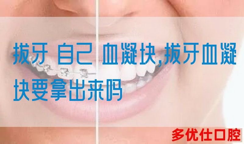 拔牙 自己 血凝块,拔牙血凝块要拿出来吗(图1)