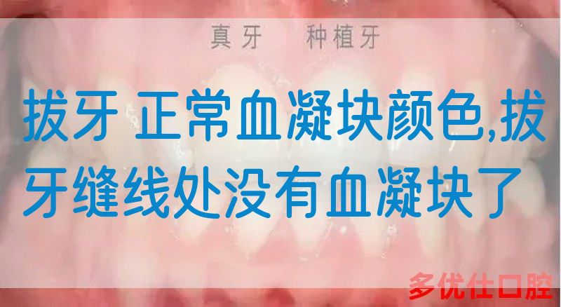 拔牙 正常血凝块颜色,拔牙缝线处没有血凝块了(图1)