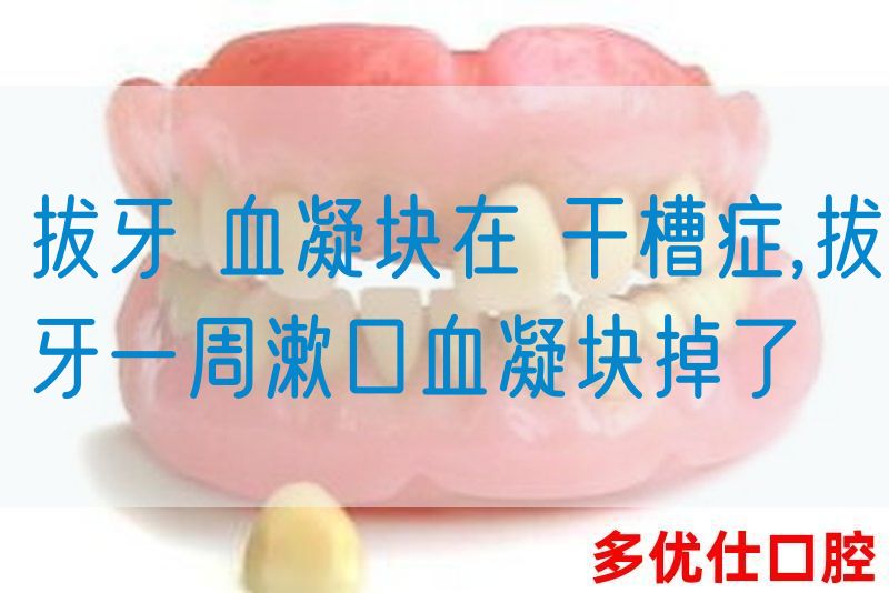 拔牙 血凝块在 干槽症,拔牙一周漱口血凝块掉了(图1)