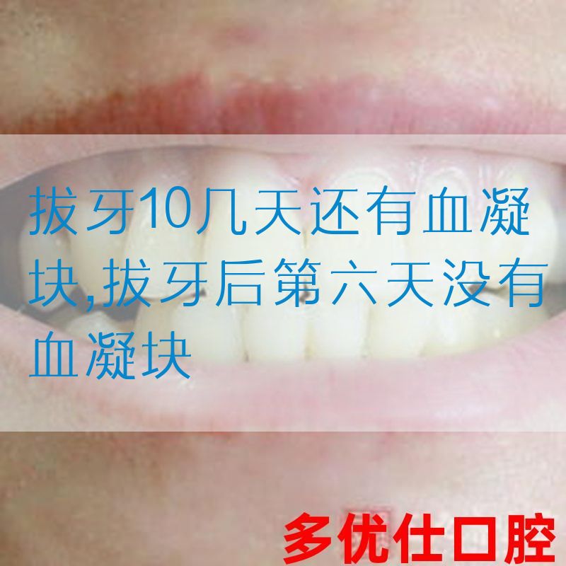拔牙10几天还有血凝块,拔牙后第六天没有血凝块(图1)