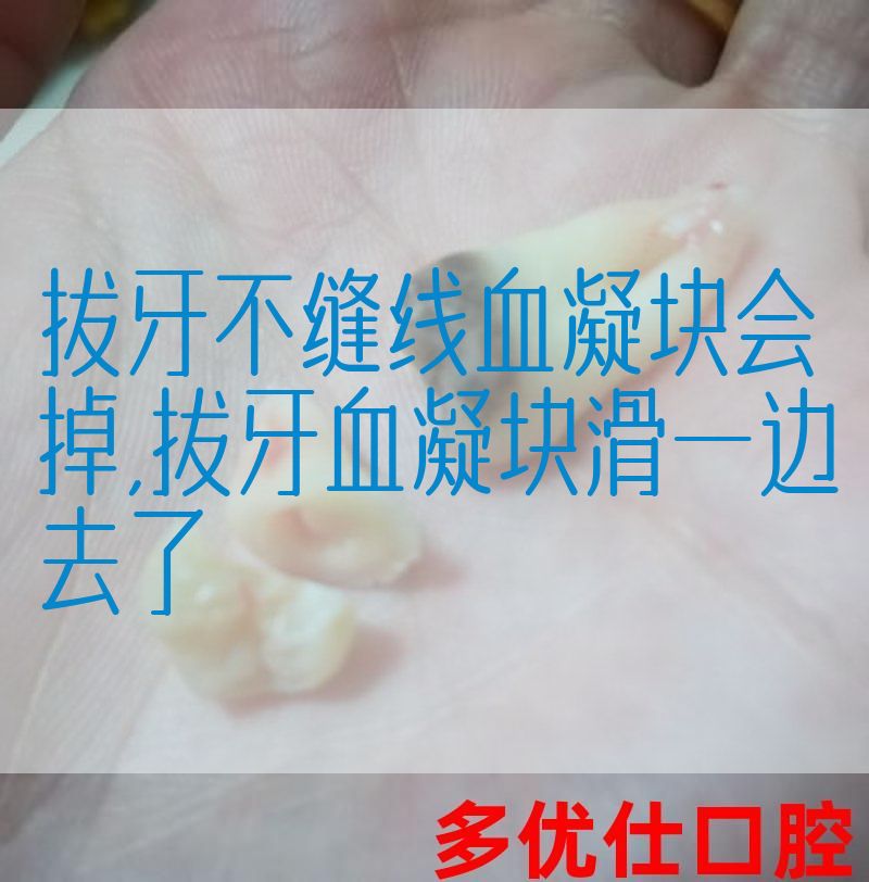 拔牙不缝线血凝块会掉,拔牙血凝块滑一边去了
