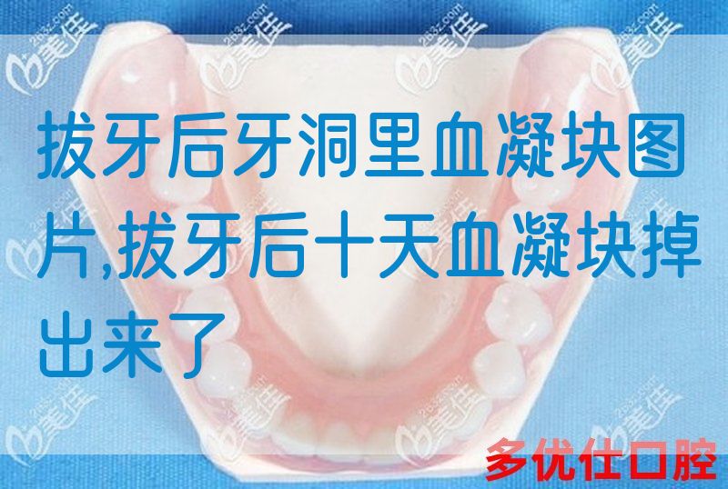 拔牙后牙洞里血凝块图片,拔牙后十天血凝块掉出来了