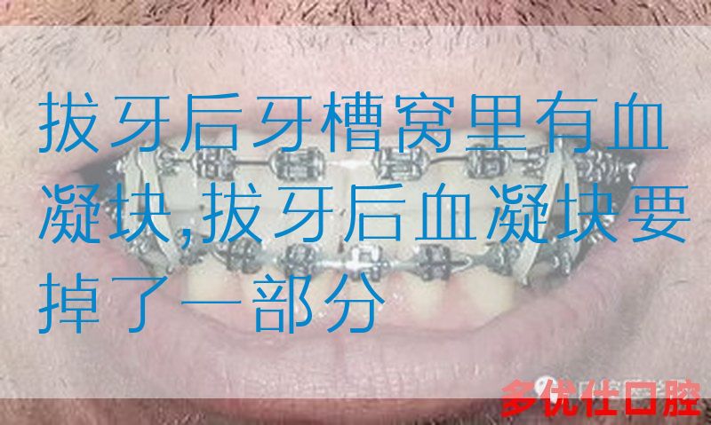 拔牙后牙槽窝里有血凝块,拔牙后血凝块要掉了一部分