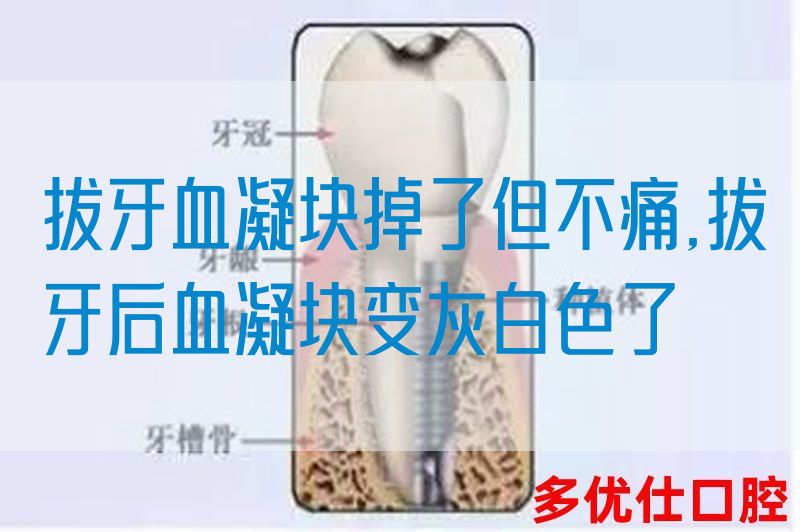 拔牙血凝块掉了但不痛,拔牙后血凝块变灰白色了