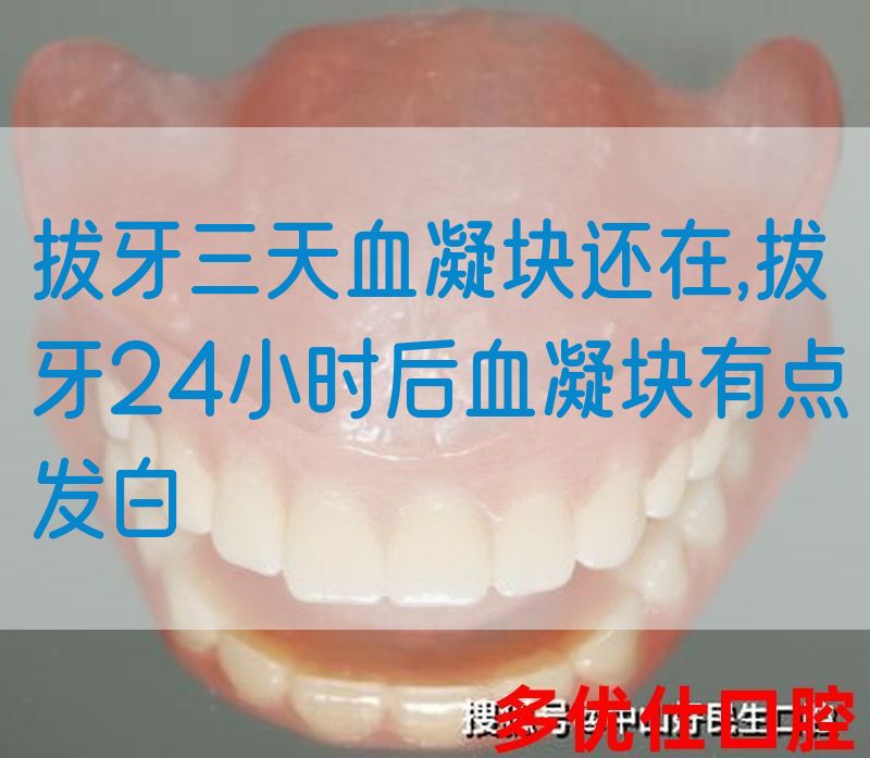 拔牙三天血凝块还在,拔牙24小时后血凝块有点发白