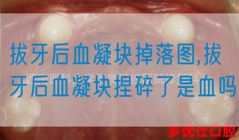 拔牙后血凝块掉落图,拔牙后血凝块捏碎了是血吗