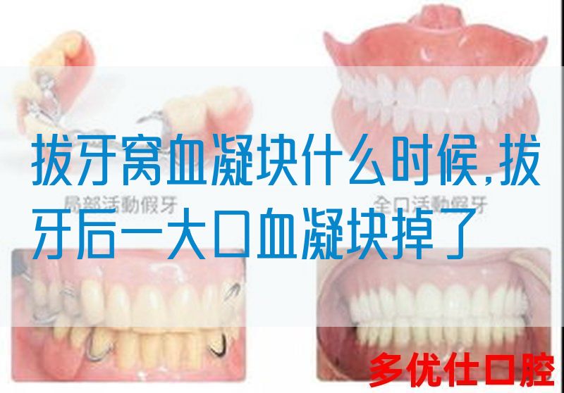 拔牙窝血凝块什么时候,拔牙后一大口血凝块掉了