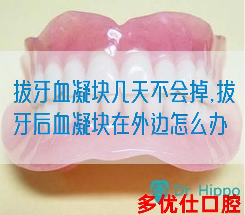 拔牙血凝块几天不会掉,拔牙后血凝块在外边怎么办