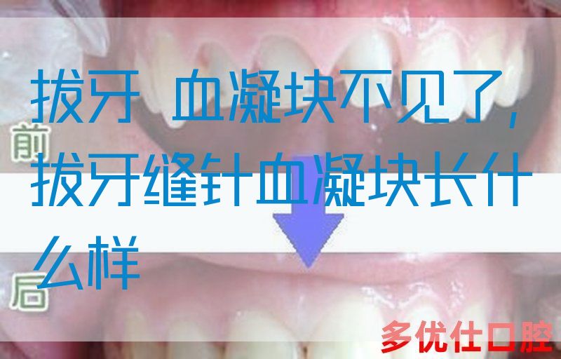拔牙 血凝块不见了,拔牙缝针血凝块长什么样
