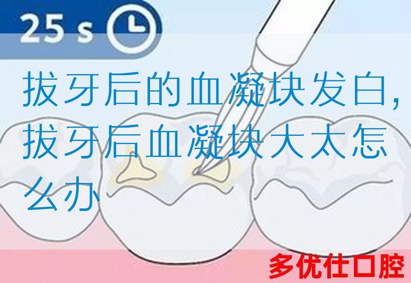 拔牙后的血凝块发白,拔牙后血凝块大太怎么办