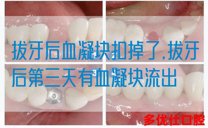 拔牙后血凝块扣掉了,拔牙后第三天有血凝块流出