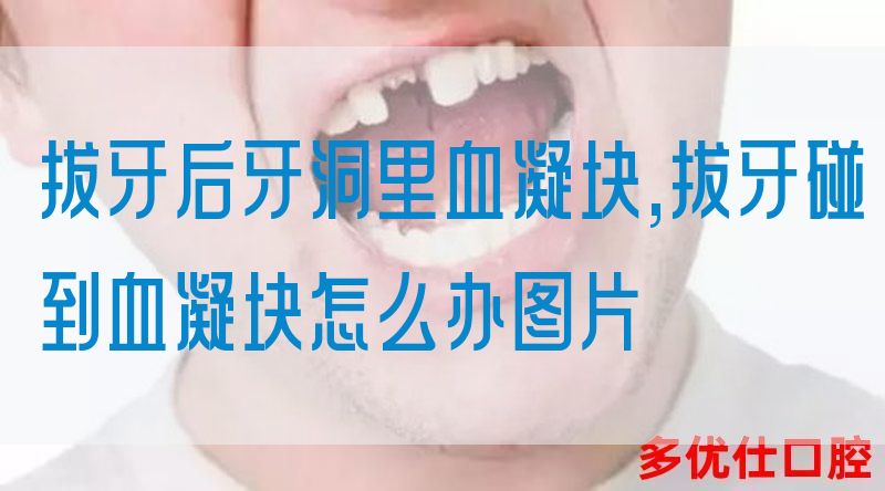 拔牙后牙洞里血凝块,拔牙碰到血凝块怎么办图片