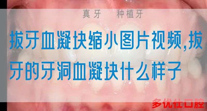 拔牙血凝块缩小图片视频,拔牙的牙洞血凝块什么样子
