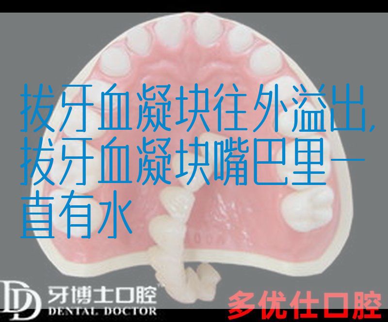拔牙血凝块往外溢出,拔牙血凝块嘴巴里一直有水