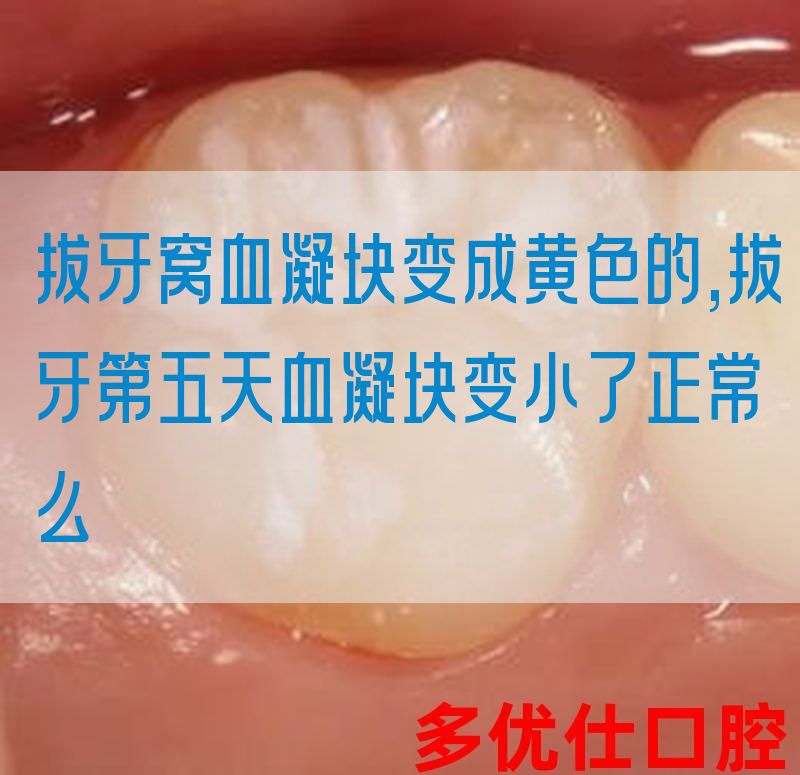 拔牙窝血凝块变成黄色的,拔牙第五天血凝块变小了正常么