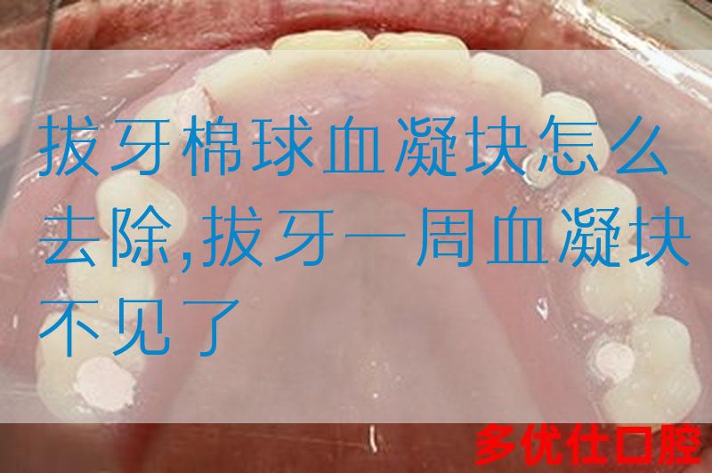 拔牙棉球血凝块怎么去除,拔牙一周血凝块不见了