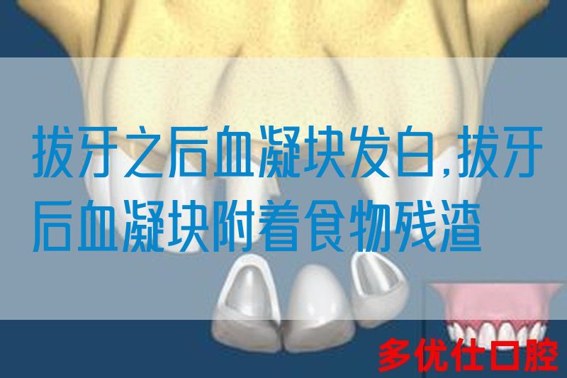 拔牙之后血凝块发白,拔牙后血凝块附着食物残渣
