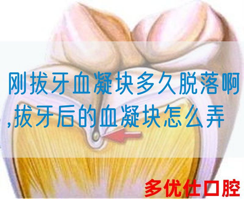 刚拔牙血凝块多久脱落啊,拔牙后的血凝块怎么弄