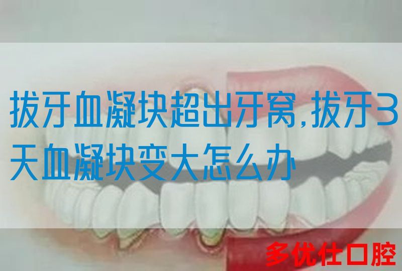 拔牙血凝块超出牙窝,拔牙3天血凝块变大怎么办