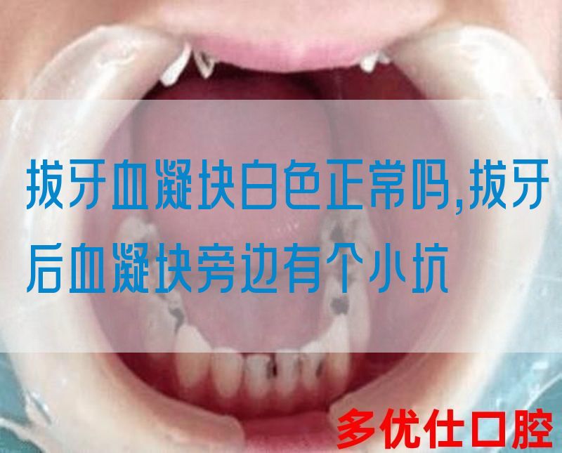 拔牙血凝块白色正常吗,拔牙后血凝块旁边有个小坑