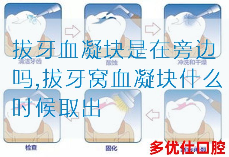 拔牙血凝块是在旁边吗,拔牙窝血凝块什么时候取出