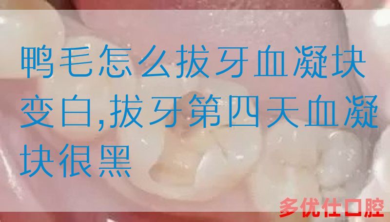 鸭毛怎么拔牙血凝块变白,拔牙第四天血凝块很黑