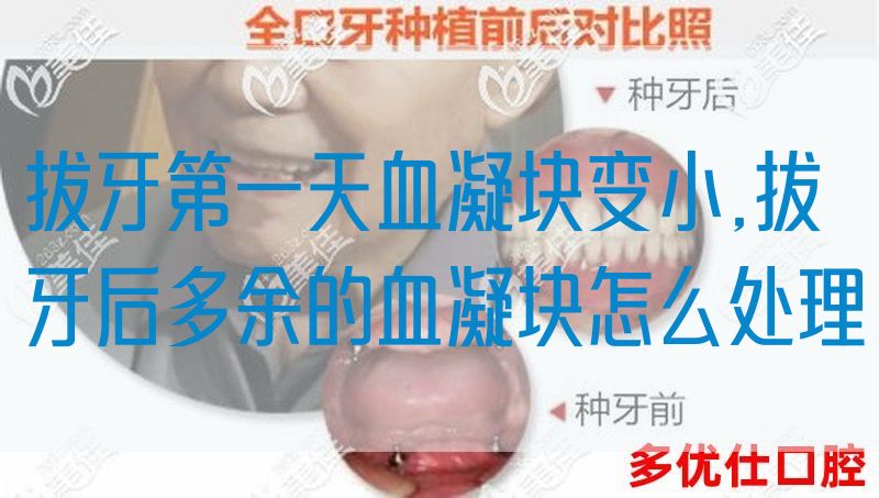 拔牙第一天血凝块变小,拔牙后多余的血凝块怎么处理