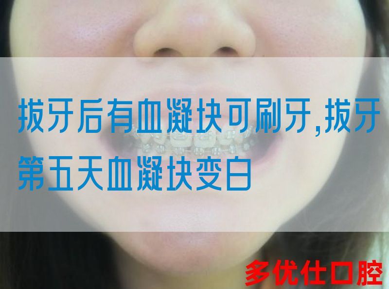 拔牙后有血凝块可刷牙,拔牙第五天血凝块变白