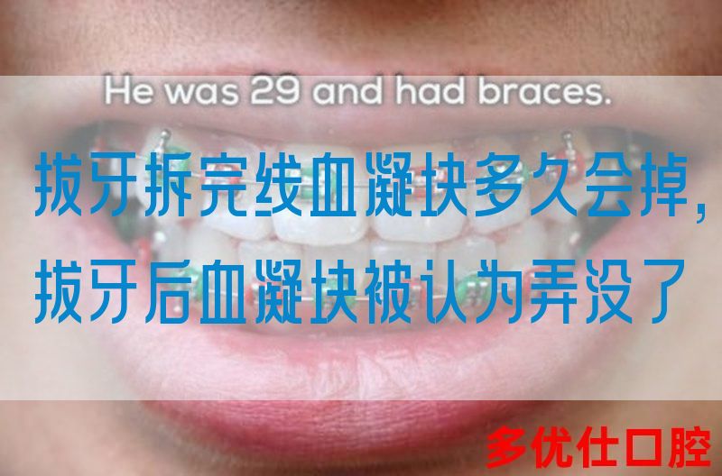 拔牙拆完线血凝块多久会掉,拔牙后血凝块被认为弄没了