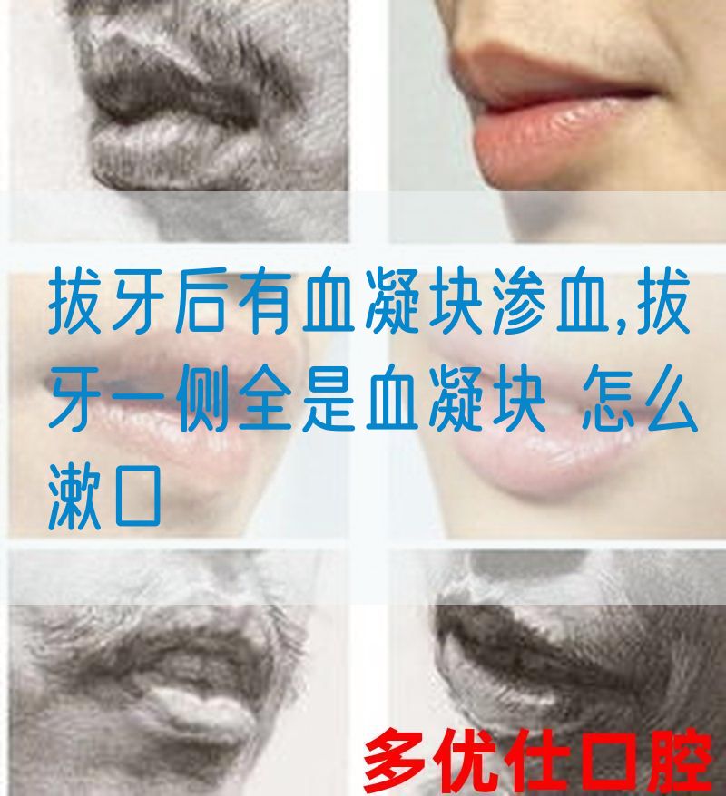 拔牙后有血凝块渗血,拔牙一侧全是血凝块 怎么漱口