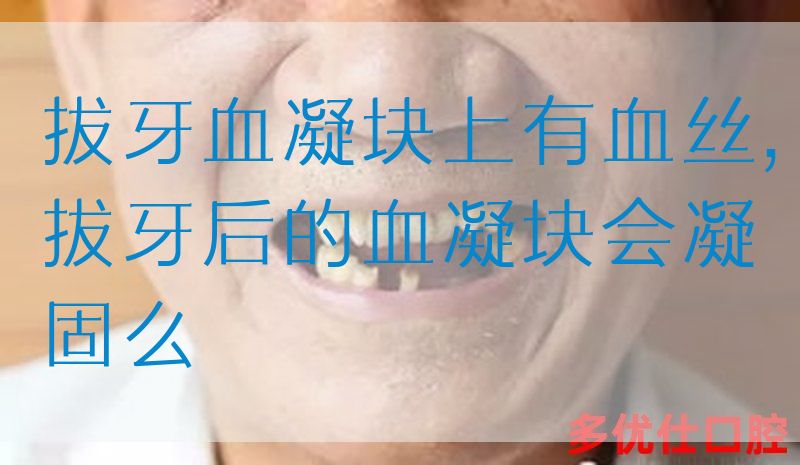 拔牙血凝块上有血丝,拔牙后的血凝块会凝固么