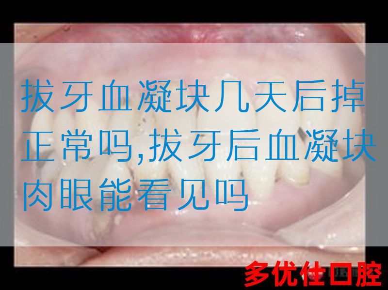 拔牙血凝块几天后掉正常吗,拔牙后血凝块肉眼能看见吗
