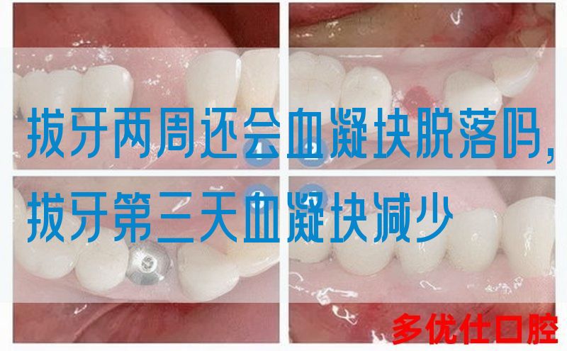 拔牙两周还会血凝块脱落吗,拔牙第三天血凝块减少