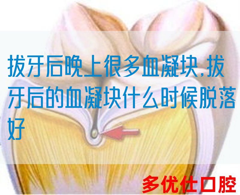 拔牙后晚上很多血凝块,拔牙后的血凝块什么时候脱落好