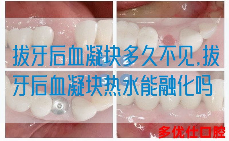 拔牙后血凝块多久不见,拔牙后血凝块热水能融化吗