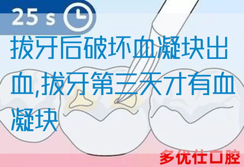 拔牙后破坏血凝块出血,拔牙第三天才有血凝块
