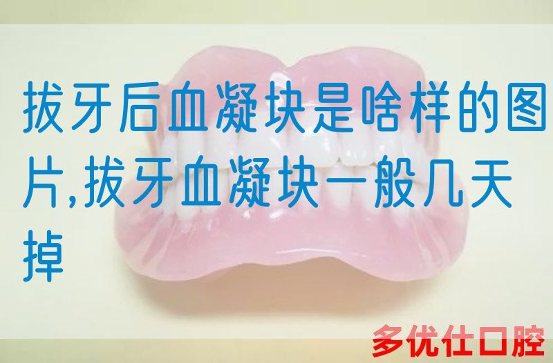 拔牙后血凝块是啥样的图片,拔牙血凝块一般几天掉