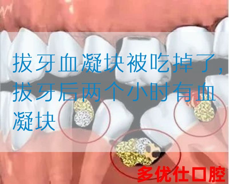 拔牙血凝块被吃掉了,拔牙后两个小时有血凝块