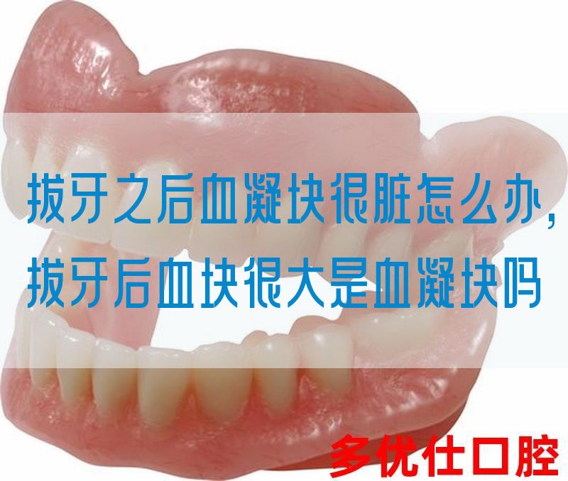 拔牙之后血凝块很脏怎么办,拔牙后血块很大是血凝块吗