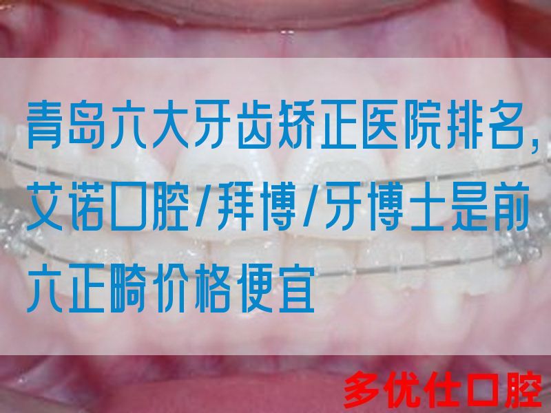 青岛六大牙齿矫正医院排名，艾诺口腔/拜博/牙博士是前六正畸价格便宜