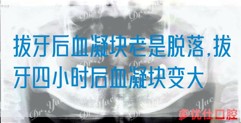 拔牙后血凝块老是脱落,拔牙四小时后血凝块变大