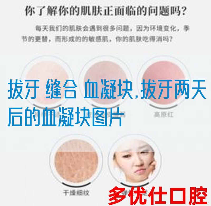 拔牙 缝合 血凝块,拔牙两天后的血凝块图片